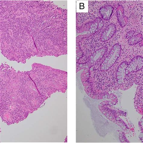 A Initial Colonic Biopsy Demonstrating Active Chronic Colitis With