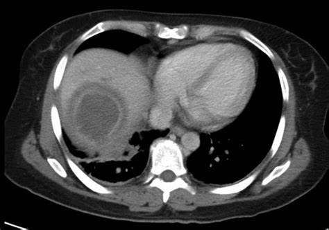 Liver Abscess The Operative Review Of Surgery