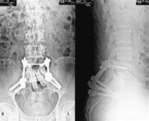 Conventional Anteroposterior And Lateral X Ray Views Of The Lower