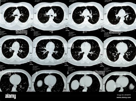 Multi Slice Ct Scan Of The Chest Showing Normal Study Normal