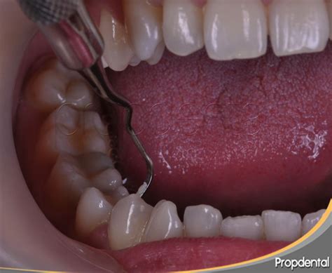 Fases Del Tratamiento Periodontal