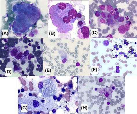 Megakaryocyte In Bone Marrow