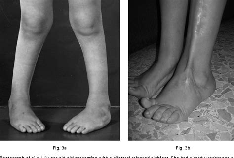 Transfer Of The Tendon Of Tibialis Anterior In Relapsed Congenital Clubfoot Long Term Results