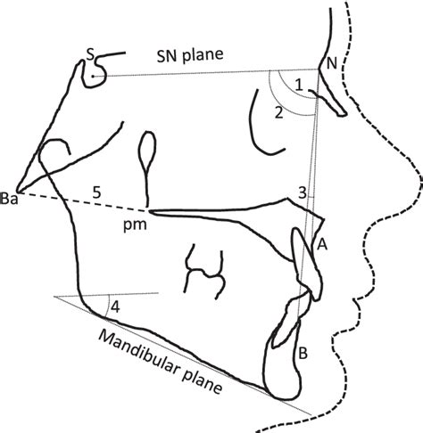 Figure 1 From Increase In Sagittal Depth Of The Bony Nasopharynx