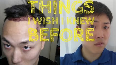 Things I Wish I Knew Before Hair Transplant Youtube