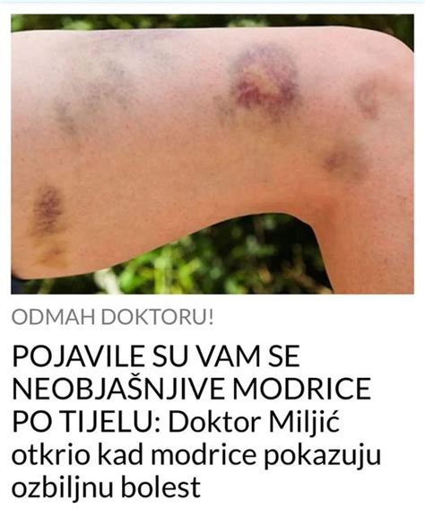 Pojavile Su Vam Se Neobja Njive Modrice Po Tijelu Doktor Milji Otkrio