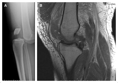 Multiligamentous Knee Injuries Acute Management Associated Jaaos