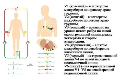 расположение электродов при снятии экг на грудной клетке по цветам