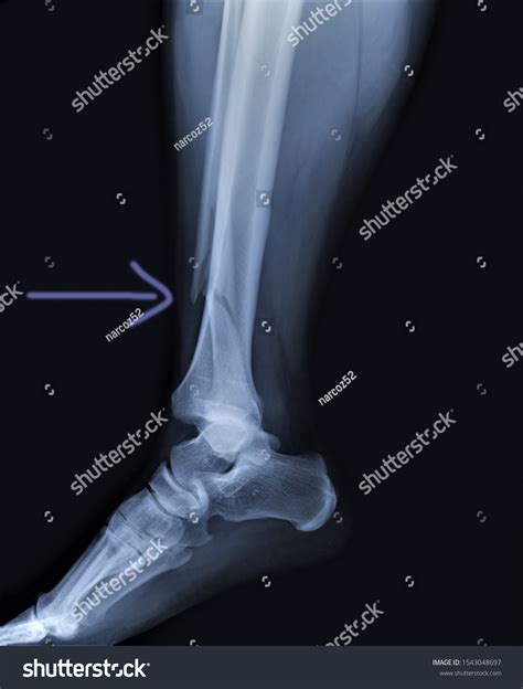 On Radiograph Fracture Fibula Medical Diagnosis Stock Photo 1543048697 ...