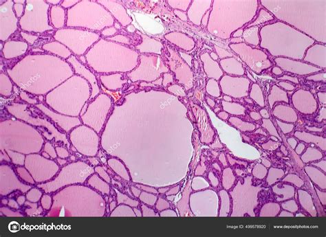 Endemic Goiter Light Micrograph Abnormal Enlargement Thyroid Gland Due