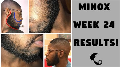 Minoxidil Beard Growth