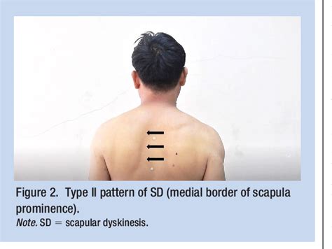 Figure From A Clinical Evaluation Of Scapular Dyskinesis Among