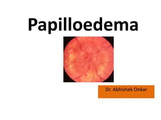 Papilloedema | PPT