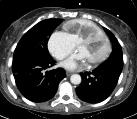 Passive Hepatic Congestion Radiology Case Radshare Net