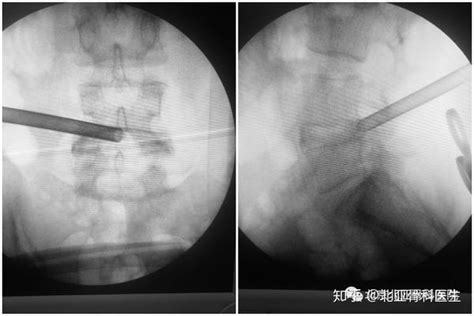 创伤小，恢复快的椎间孔镜微创技术，及时帮助急性腰椎间盘突出患者解除病痛！ 知乎