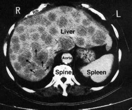 Liver Cancer: Liver Cancer Ct Scan