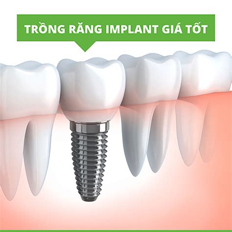 Tr Ng R Ng Implant