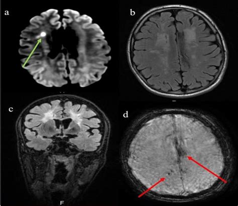 Second Brain Mri Year Later In The Image A The Dwi Sequence