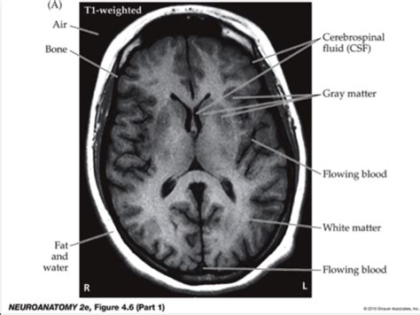 Mri Flashcards Quizlet