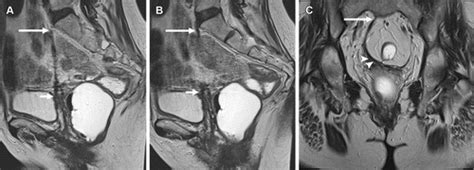 Multimodality Imaging Of Anterior Compartment Pelvic Floor Repair