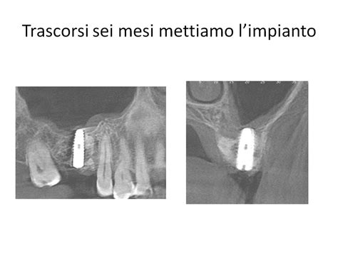 Frattura Radicolare Rigenerazione Impianto Dentista Roma