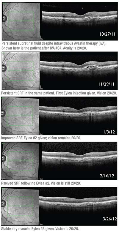 Avastin Eye Injection : Side Effects Of Avastin Injections In The Eye ...