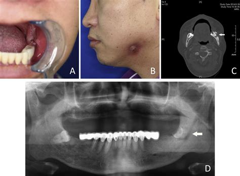 Retrospective Analysis Of Osteoradionecrosis Of The Mandible Proposing