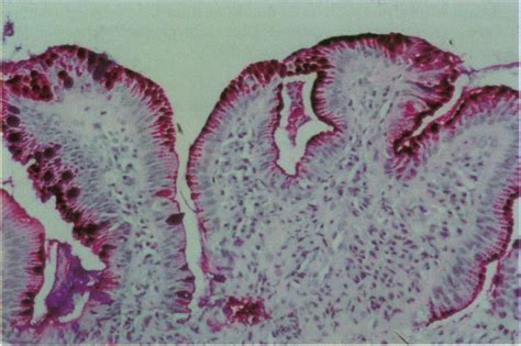 Section Ofa Duodenal Biopsy Specimen Stained With Diastase Pasalcian