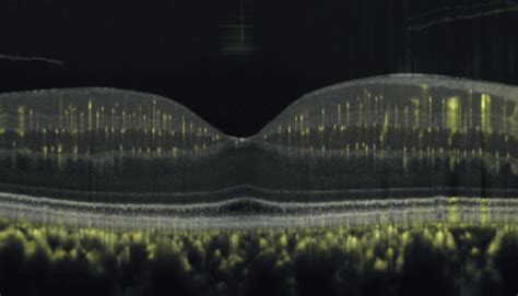 High Resolution Oct From Heidelberg Engineering