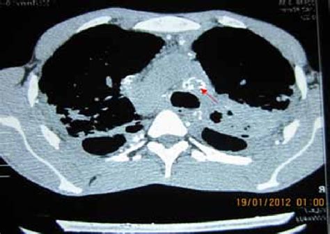 Egg Shell Calcification Seen In The Mediastinal And Hilar Lymph Nodes Download Scientific Diagram