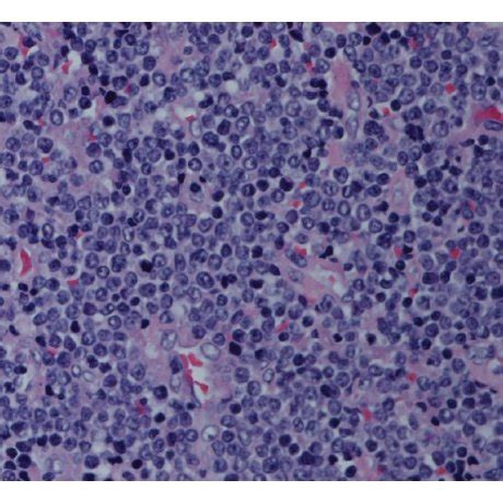 Supraclavicular lymph node biopsy ((a) H&E, 40x; (b) IHC stain for CD3 ...