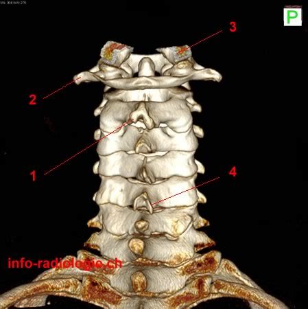 Anatomie Rachis Cervical