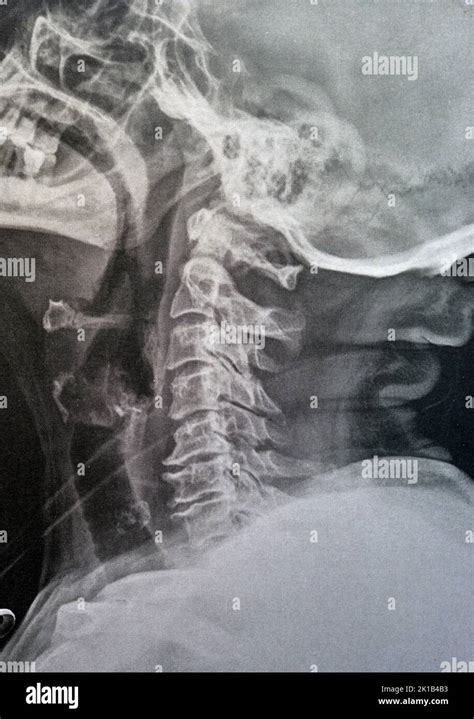 Plain X Ray Cervical Vertebrae Showing Straightening Of Cervical