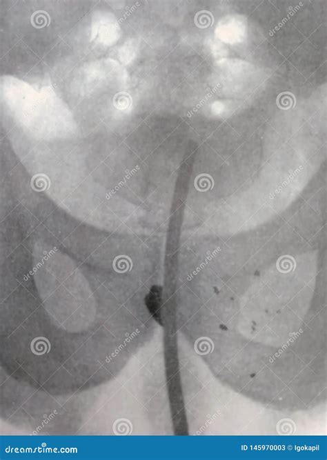 Xray Examination Abdomen Pelvis Gunshot War Victim Stock Photography