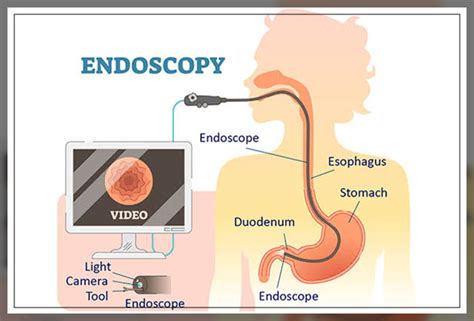 Biopsy Test: Types, Procedure, and More - Engiomed