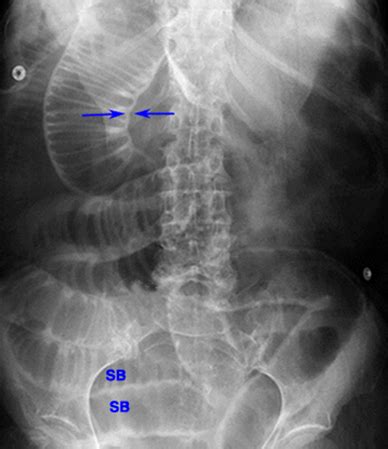 abdominal perforated viscus flashcards quizlet