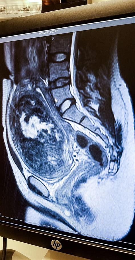 My Fibroid Story: From Start to Almost Finish - Laparoscopic Myomectomy