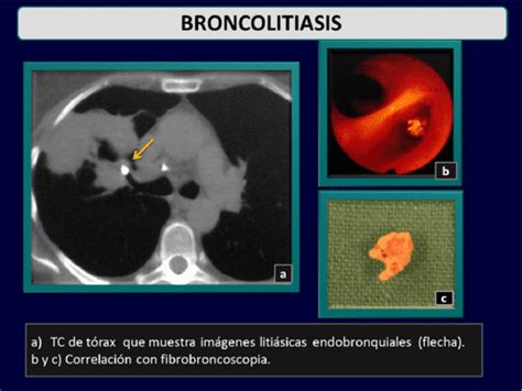 Figure From Manifestaciones Radiol Gicas De La Tuberculosis Pulmonar