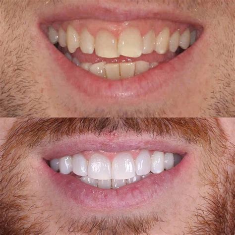 Resultados Espectaculares Con Ortodoncia Invisible Invisalign Clinica