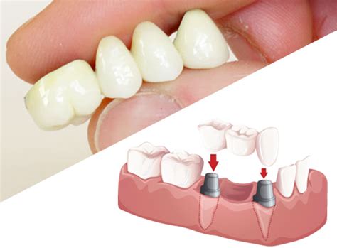 Poa Odontologia Pr Teses Dent Rias Aruj Dr Almir Feitosa