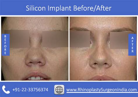 Silicone Implant | Rhinoplasty Surgeon India