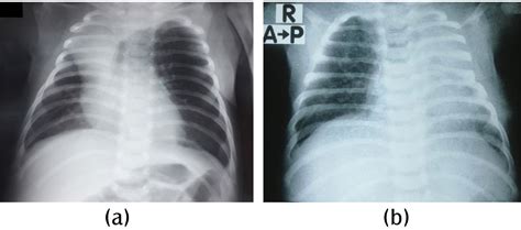 Congenital Lobar Emphysema Case Report A Frequently Misdiag