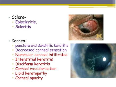 herpes zoster ophthalmicus pptx