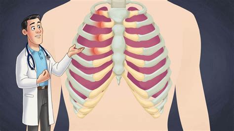 What is Costochondritis Symptoms , Causes, Treatment - Healthy Magazine