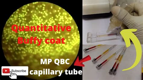 MP QBC Test Quantitative Buffy Coat Test Process In Microscope