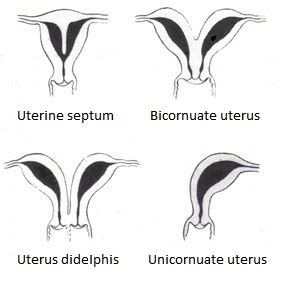 Unicornuate Uterus Wikipedia