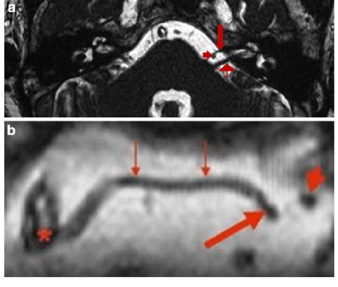 Axial A 3d Fiesta Image In A 49 Year Old Man Without Clinical Download Scientific Diagram