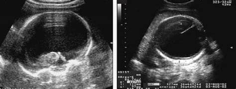 Hydranencephaly Ultrasound