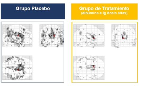 El Estudio Cl Nico Ambar Demuestra Reducci N Del Alzheimer