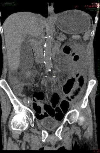 Pneumoperitoneum Ct Image Download Scientific Diagram